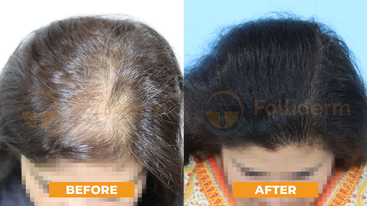flawless hair removal before and after