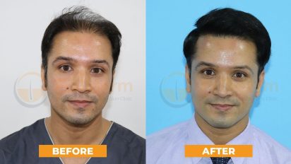 success stories baldness grade 6