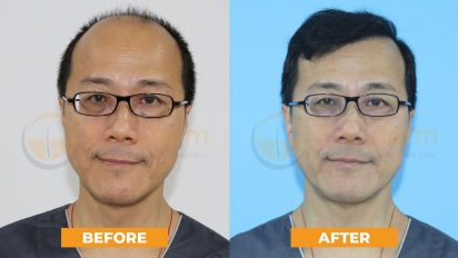 Success stories baldness grade 6