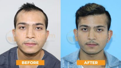 Success stories baldness grade 3