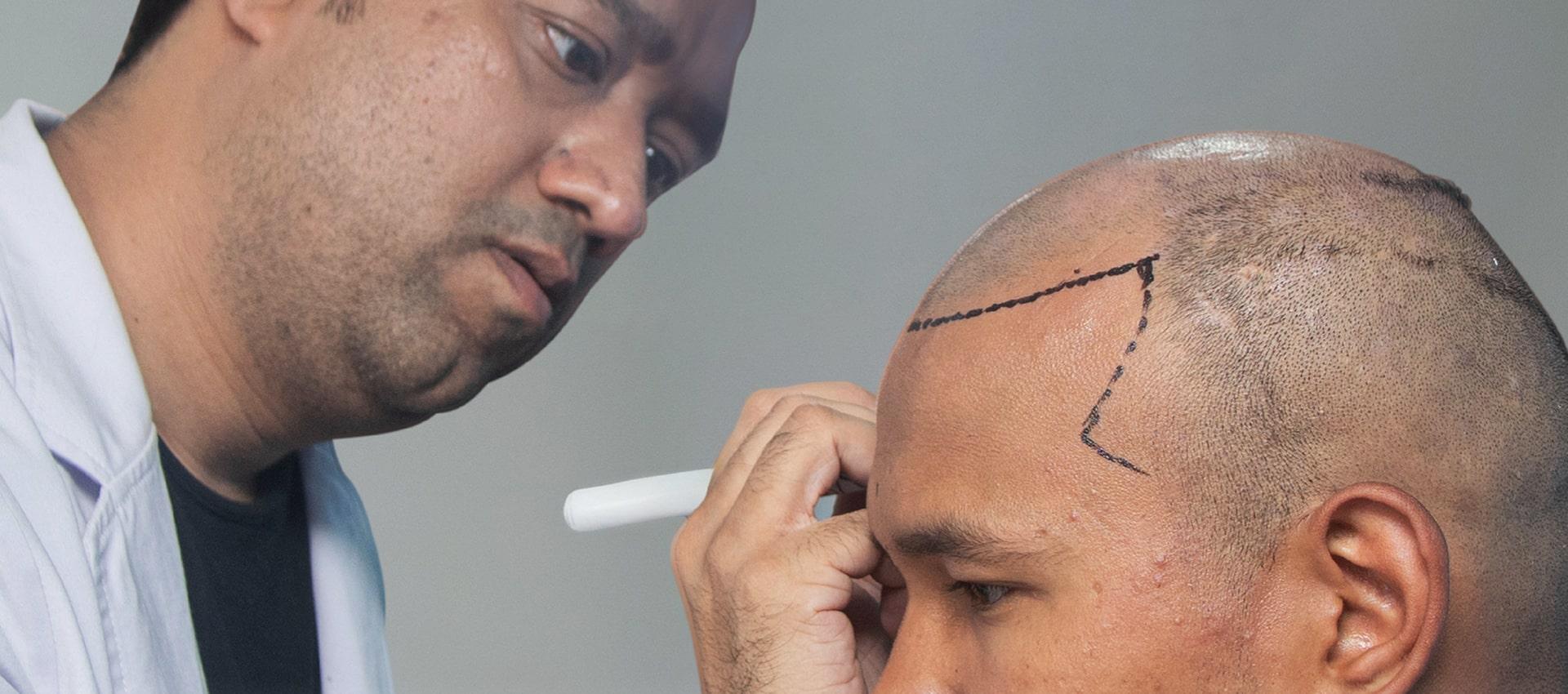 Globally Trusted Hair Transplant Expert